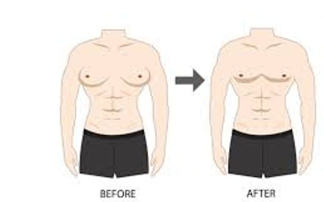 gynecomastia