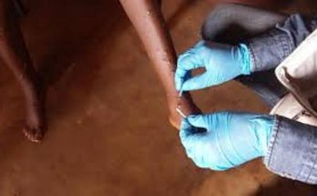 mpox